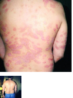 Нетрадиционная медицина объявление но. 1013487: Распространенный псориаз