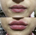 Косметика, парфюмерия объявление но. 1726642: Услуги от косметолога с медицинским образованием