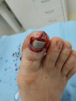 Медицинские услуги объявление но. 1739271: Лечение язвы на ноге