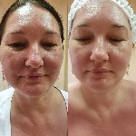 Косметика, парфюмерия объявление но. 1853619: SMAS лифтинг